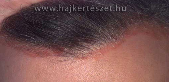 Eucerin®: Fejbőr- és hajproblémák | Az érzékeny fejbőrről